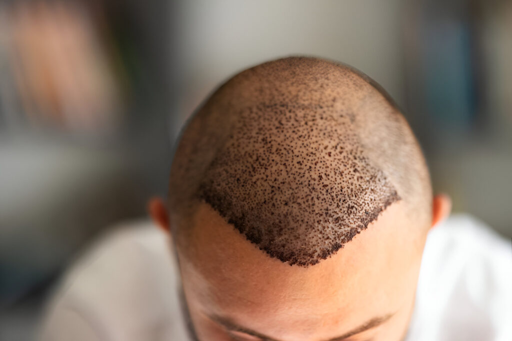 hair transplant in Islamabad