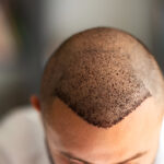 hair transplant in Islamabad