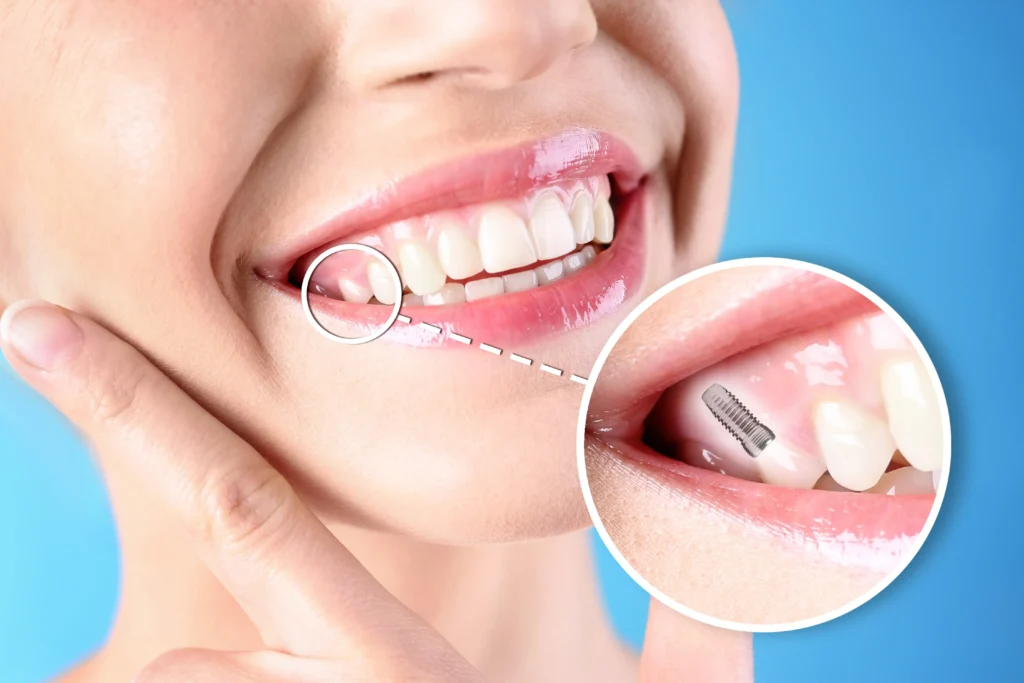best single tooth implant chattanooga tn