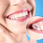 best single tooth implant chattanooga tn