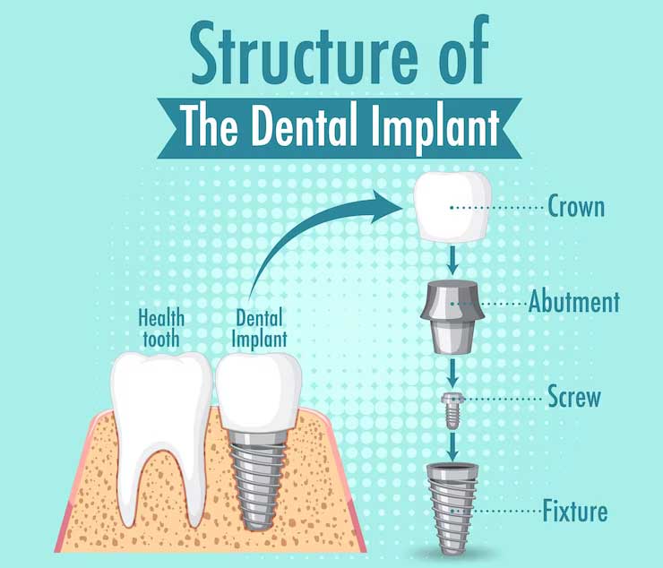 dentalimplants-1 (1)