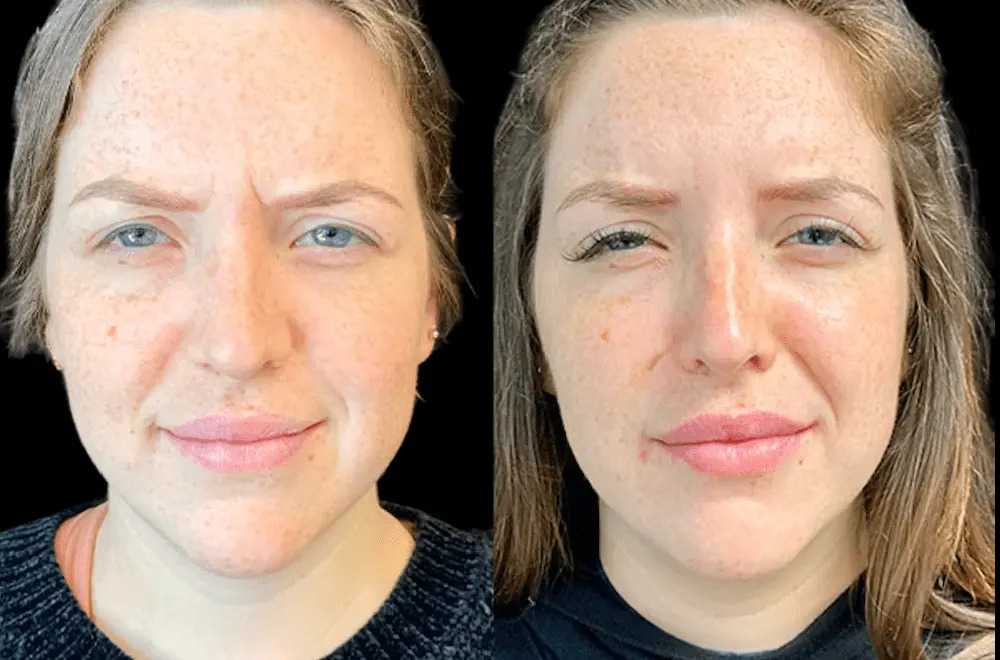 Botox for Frown Lines at Best Aesthetic Clinics in Dubai