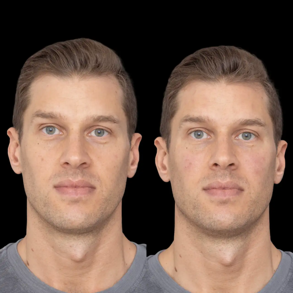 jawline filler in dubai