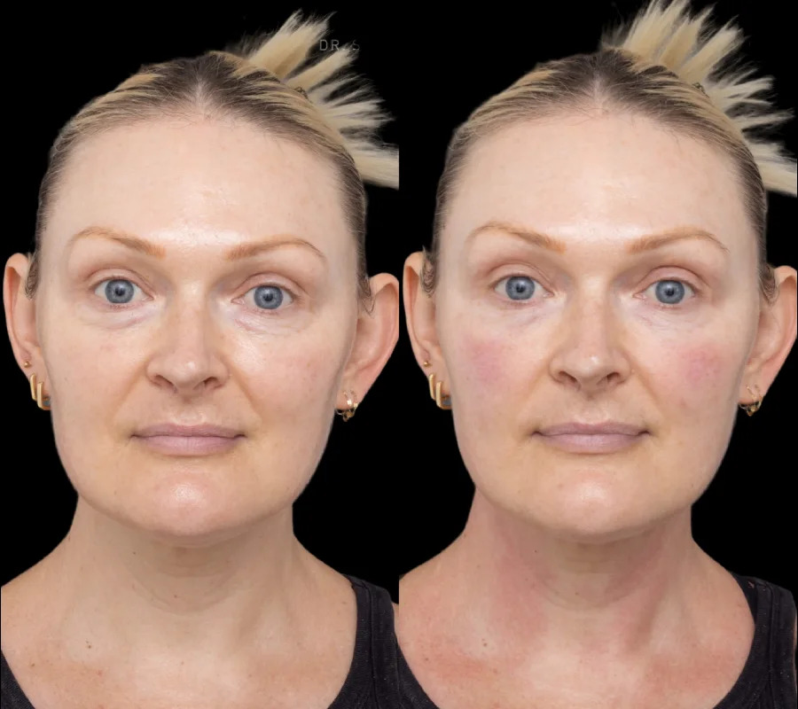 Under eye fillers