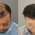 زراعة الشعر في دبي
