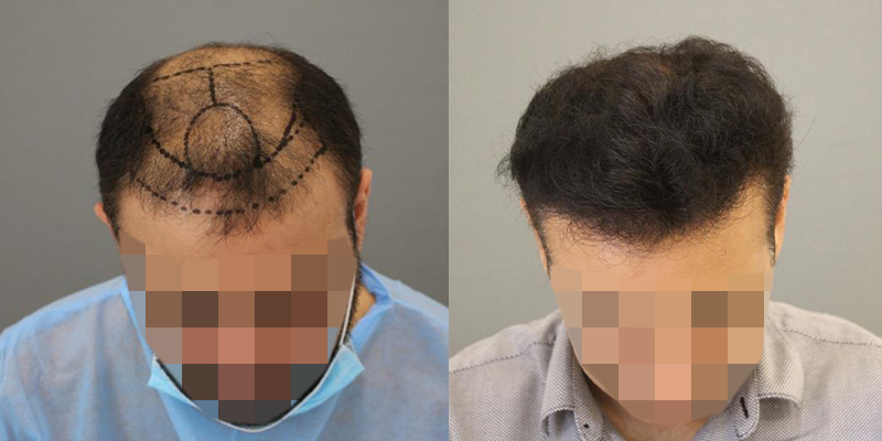 زراعة الشعر في دبي
