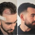 hair transplant in islamabad