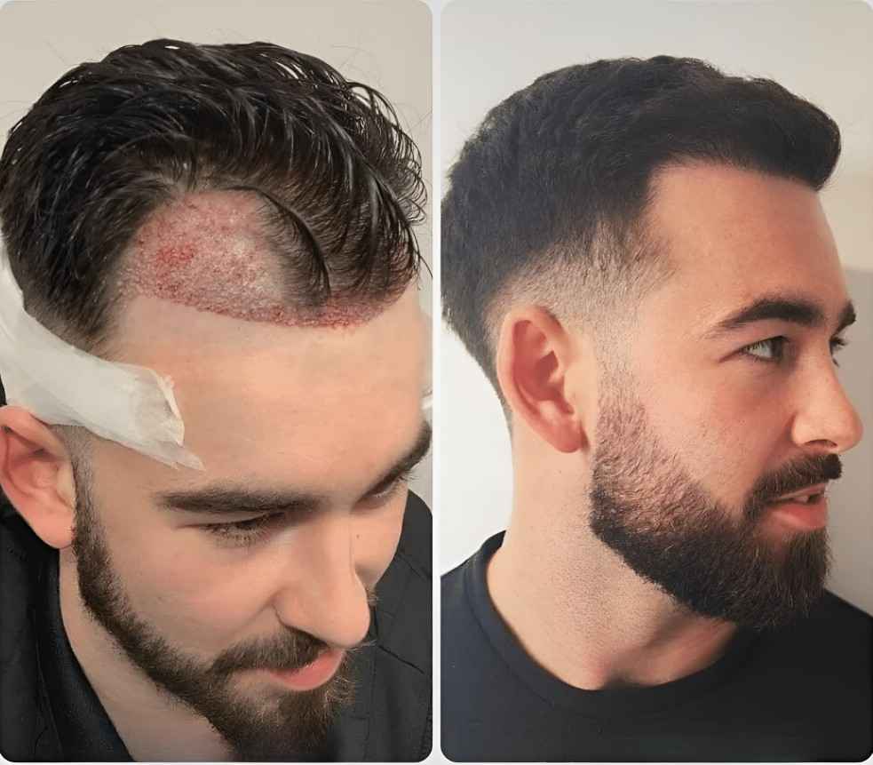 hair transplant in islamabad