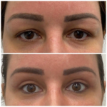 Eye Bag Removal in Dubai