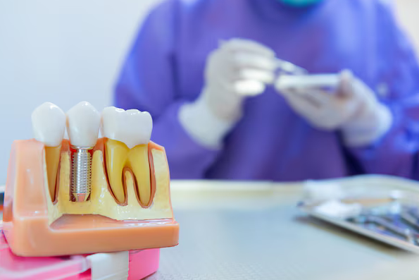 implant dentist elberta al