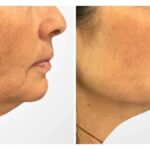 Best Aesthetic Clinics in Dubai Providing Expert Thread Lift Solutions