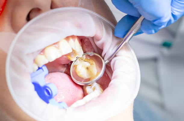 white fillings bowling green ky