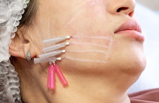 thread lift in islamabad