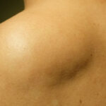 lipoma treatment in Islamabad