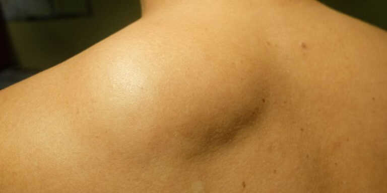lipoma treatment in Islamabad