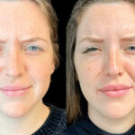 Botox in Dubai for Natural-Looking Enhancements