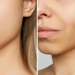 Buccal Fat Removal