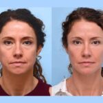 Best Plastic Surgeon in Dubai Providing Advanced Thread Lift