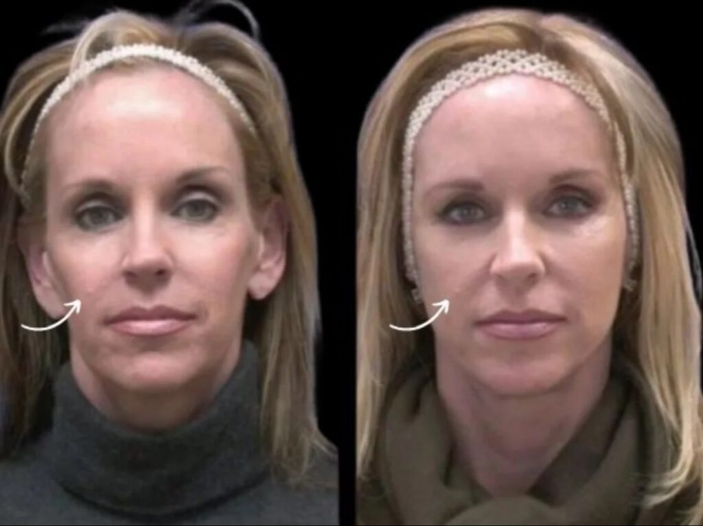 Sculptra fillers in dubai