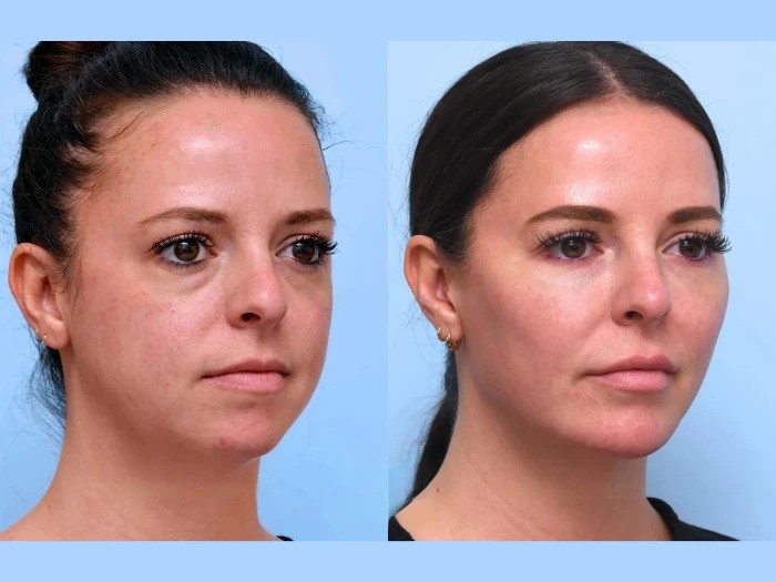Thread lift in Dubai Trusted by Patients Seeking Non Invasive Face Lifting