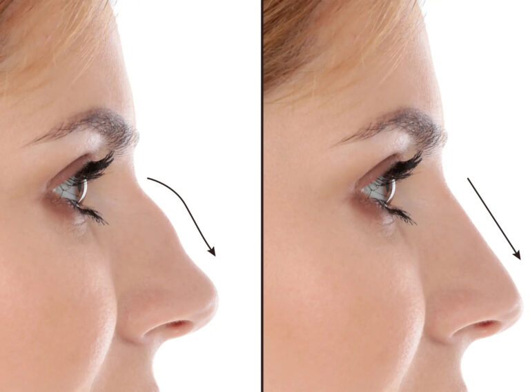 Septoplasty in Dubai