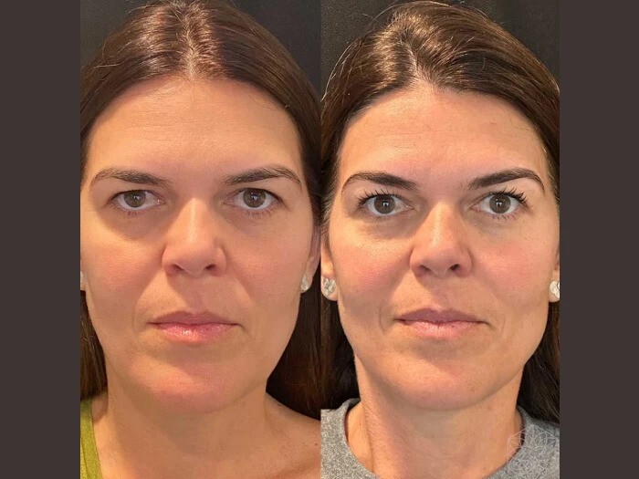 Best Aesthetic Clinic in Dubai Featuring Innovative Thread Lift Techniques