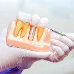 implant dentistry laurel md