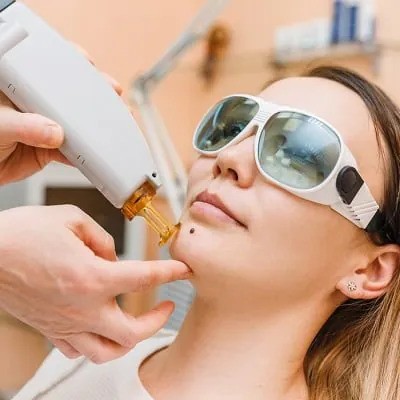 laser mole removal in islamabad