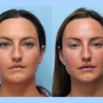 Thread Lift Treatment in Dubai Using Advanced Techniques For Safe Subtle Facial Lifting