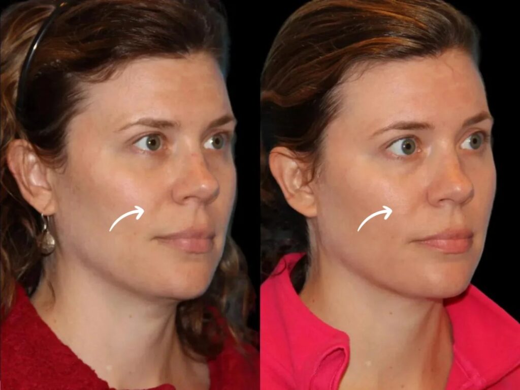 sculptra in dubai