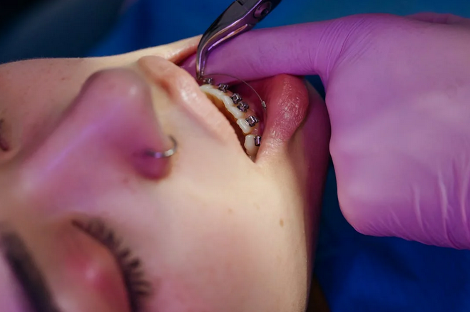 braces san antonio