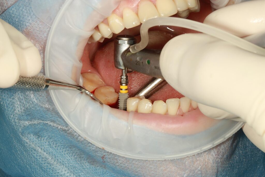 dental implants near glendale az