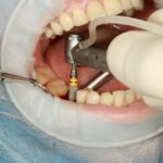 dental implants near glendale az