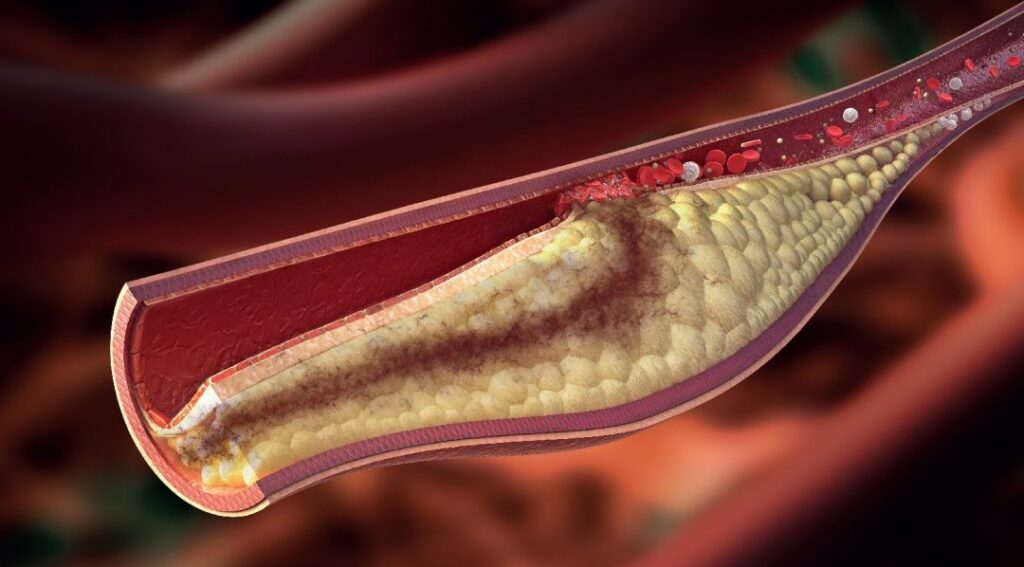 dr-barbara-HYPERCHOLESTEROLEMIA