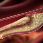 dr-barbara-HYPERCHOLESTEROLEMIA