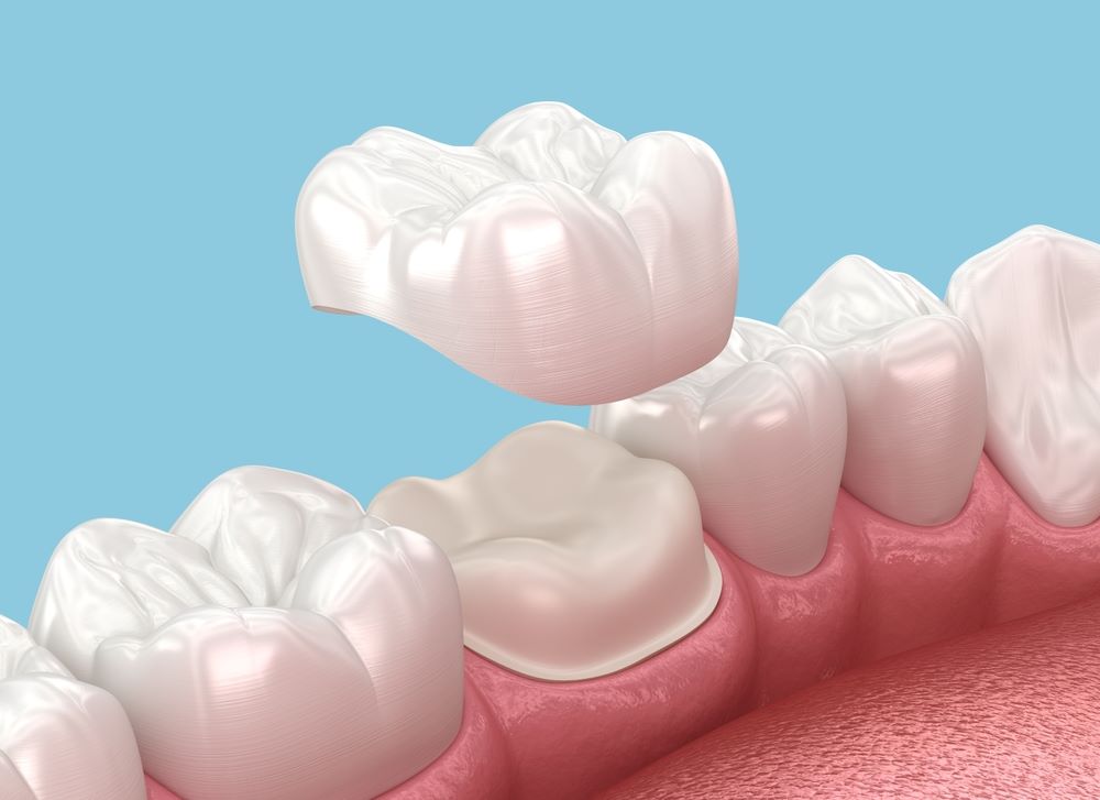 understanding-dental-crowns-and-bridges-what-they-are-and-how-they-work