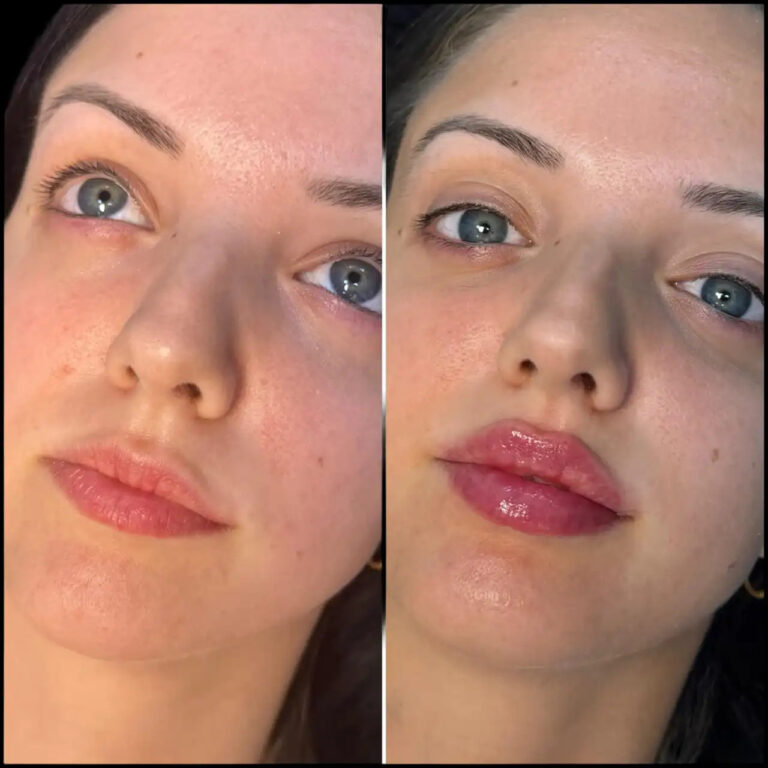 dermal fillers