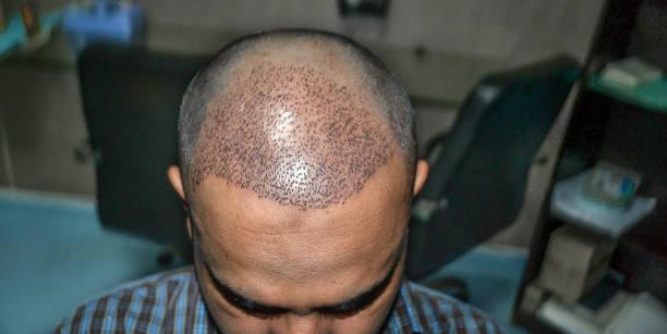 زراعة الشعر في دبي