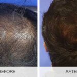 زراعة الشعر في دبي