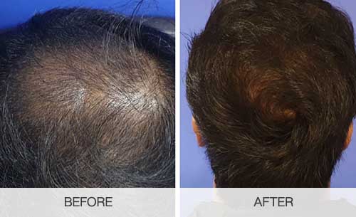 زراعة الشعر في دبي
