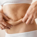 Liposuction in Dubai