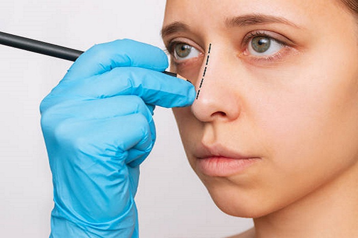 Rhinoplasty in Riyadh