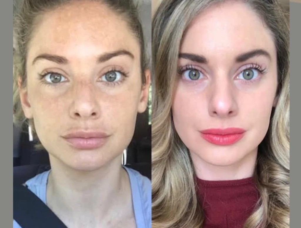 RF Microneedling in Dubai