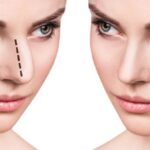 Rhinoplasty in Riyadh