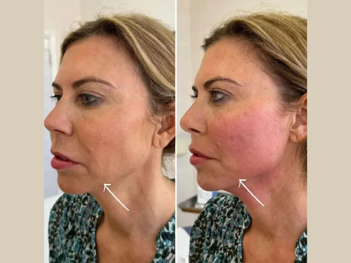 Endolift Treatments in Dubai for Safe and Precise Facial Rejuvenation