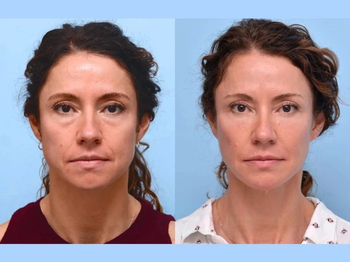 Thread lift Treatment in Dubai Supporting Elegant Beauty Through PDO Procedures