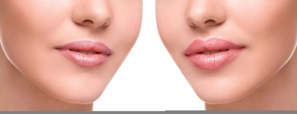 Lip Augmentation in Riyadh