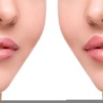 Lip Augmentation in Riyadh
