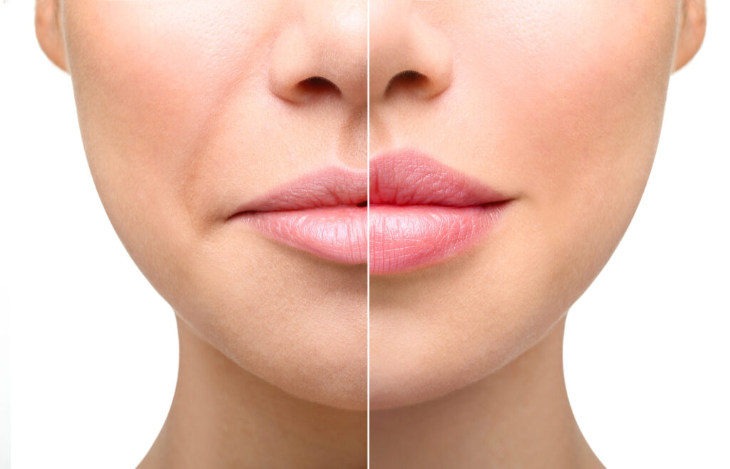 Lip Enlargement in Riyadh