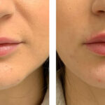 Lip Enlargement in Riyadh